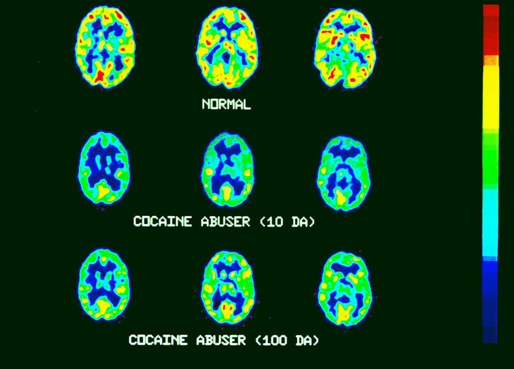 Quels sont les effets de la cocaïne sur votre cerveau ?  CogniFit's Blog