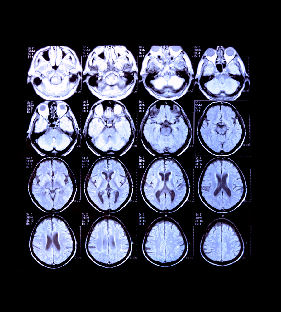 Neuroimaging: What Is It And How Can It Map The Brain?