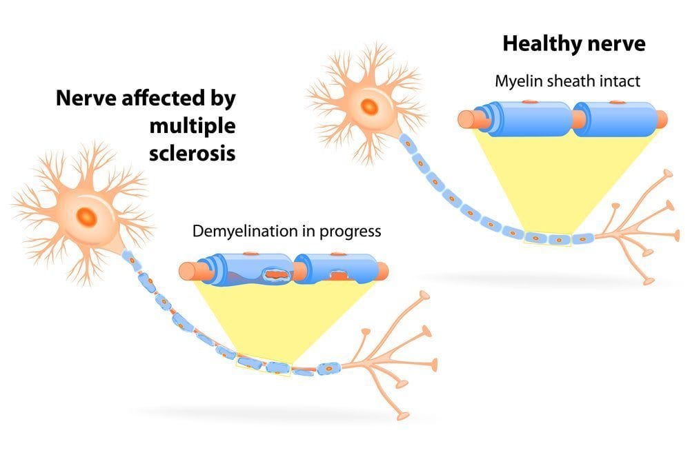 Demyelinating Diseases: A useful guide to diseases involving myelin