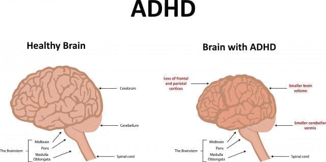 What Causes ADHD: Comparing Facts and Myths - Health ...