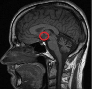 Hipotálamo: La importancia de las hormonas en el cerebro Hipotálamo: La importancia de las hormonas en el cerebro